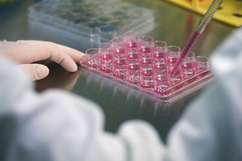 Sclerosi Multipla: concluso il trial clinico di Fase I con trapianto di staminali cerebrali a Casa Sollievo